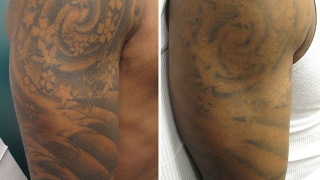 Tattoo Laser Removal – 3 Reasons Why Your Tattoo May Prefer To Go!