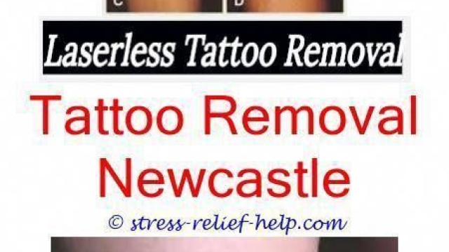 Tattoo Removal Cream Information – Are Tattoo Removal Creams Any Money?