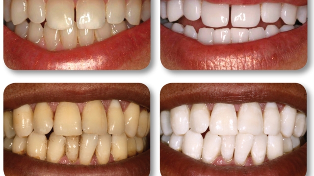 Sparkling Smiles: Unveiling the Secrets of Teeth Whitening